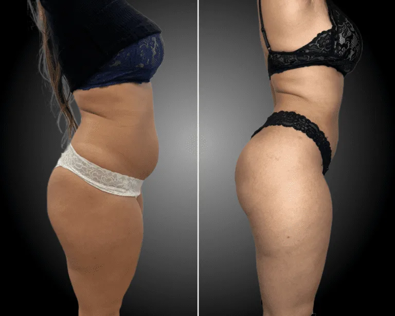 Liposuzione,Liposcultura