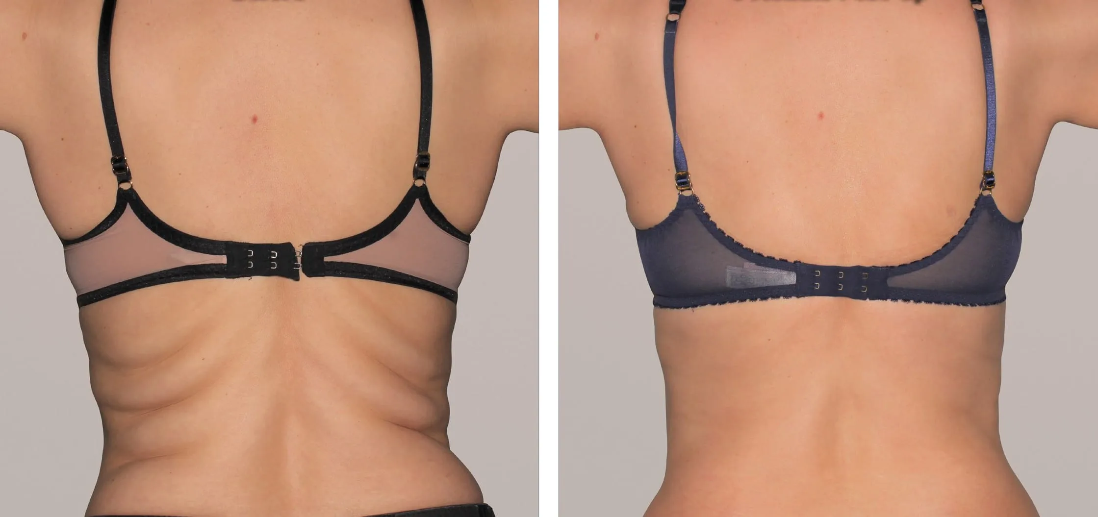 Liposuzione,Liposcultura