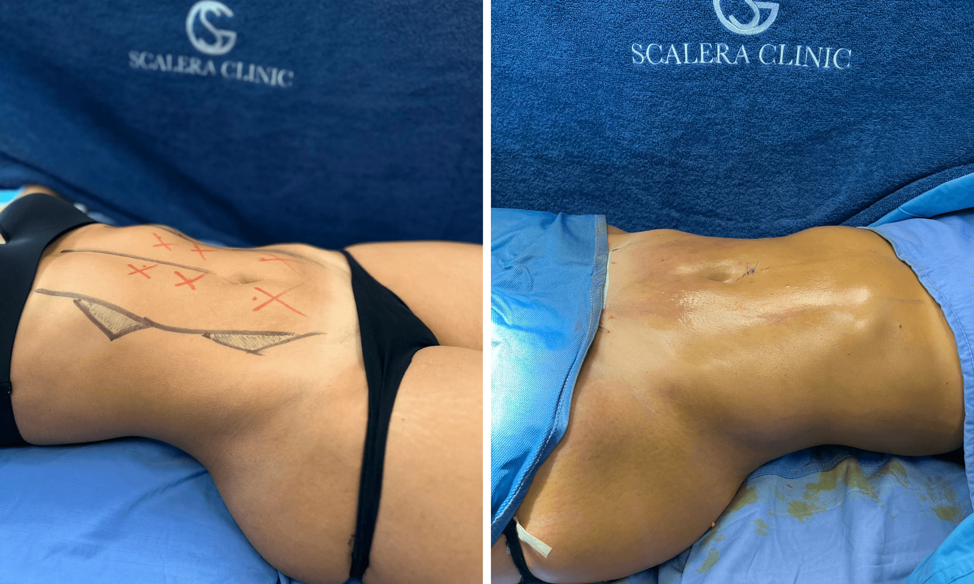 Liposuzione,Liposcultura