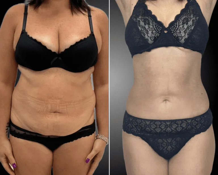 Liposuzione,Liposcultura