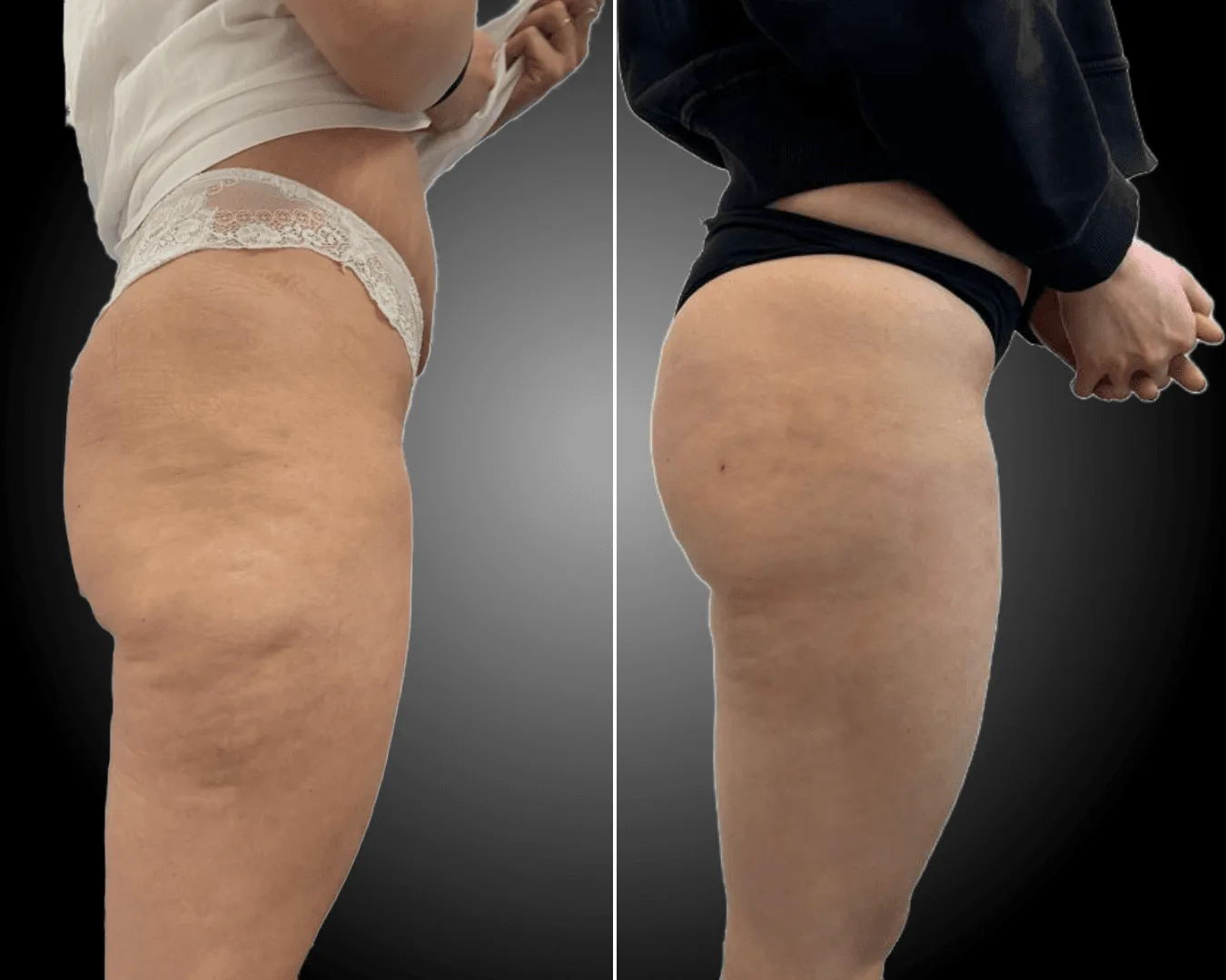 Liposuzione,Liposcultura