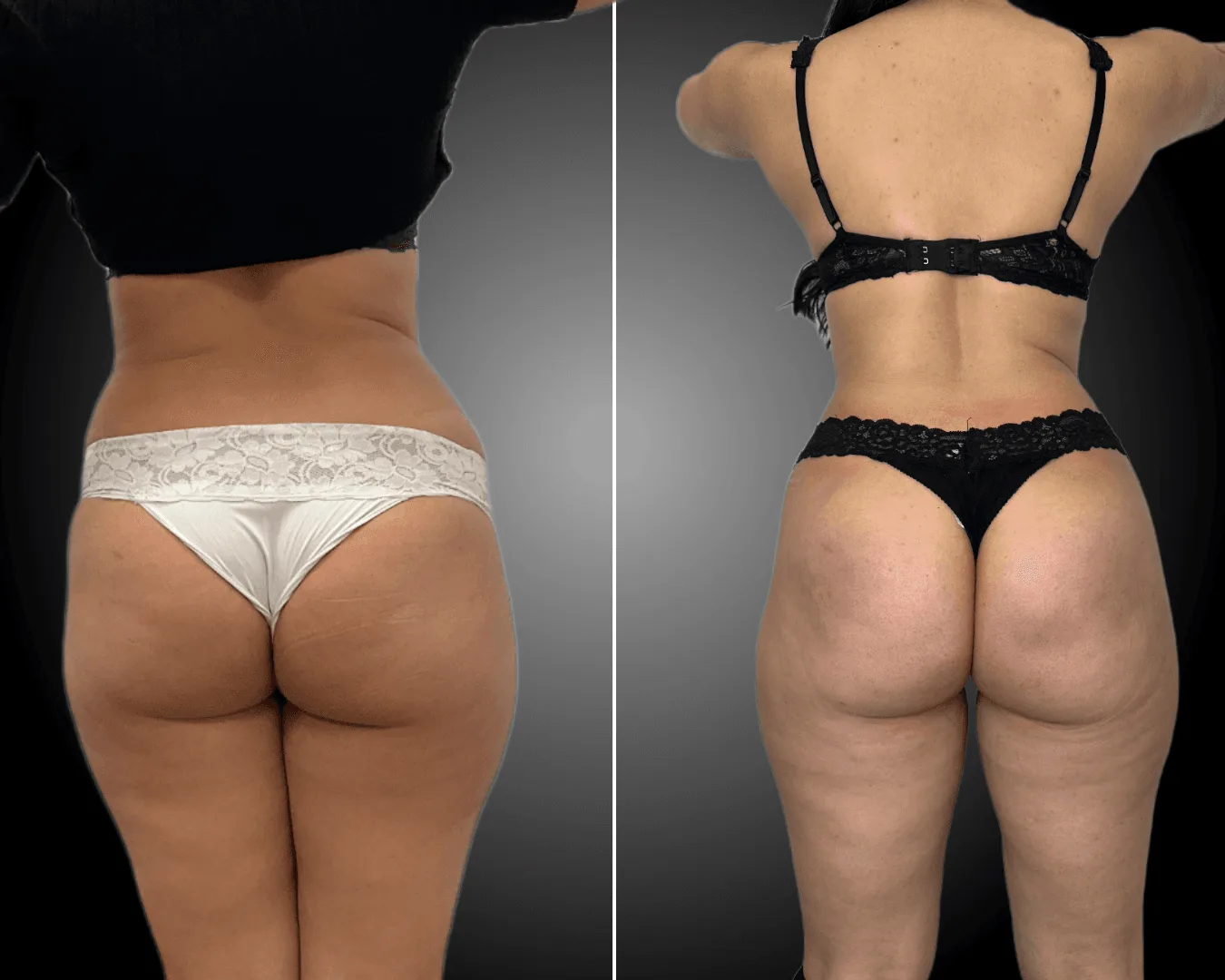 Liposuzione,Liposcultura